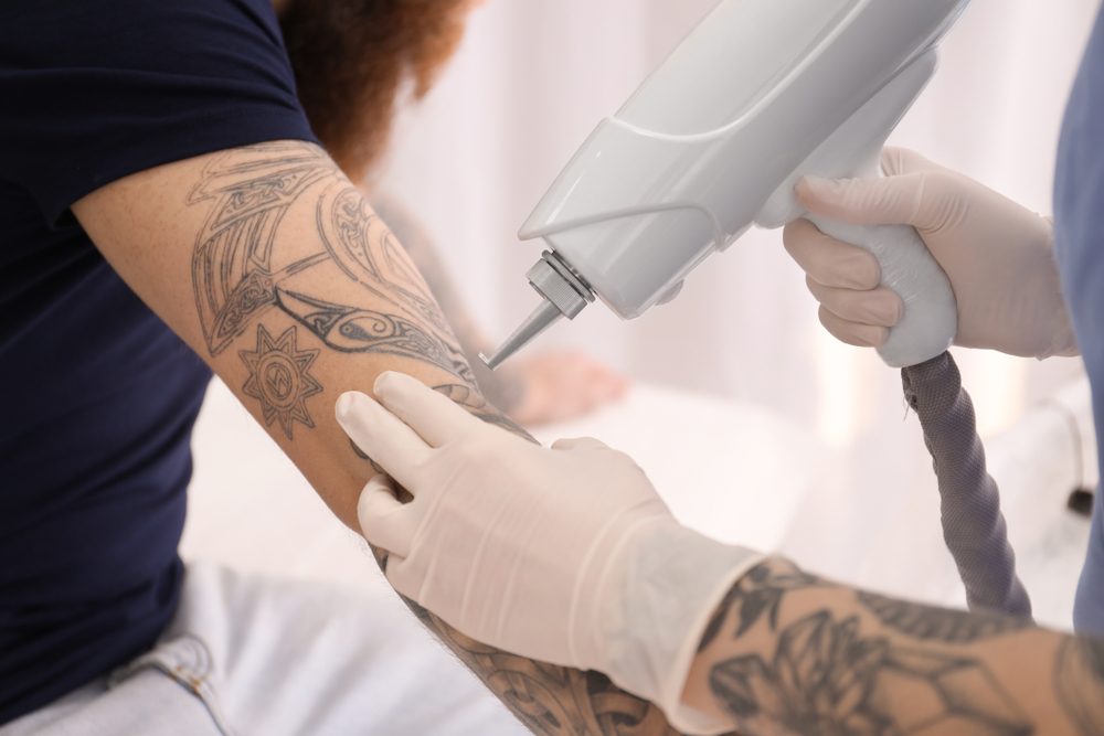 Tattoo Removal Business